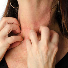 Lupénka je nejen fyzický, ale také psychický problém. Podívejte se do fotogalerie, kam až může dojít