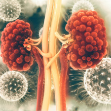 Polycystická choroba ledvin je dědičné onemocnění ledvin, které své nositele značně poškozuje a může je i ohrozit na životě