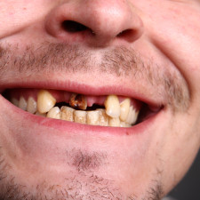 Jedním z příznaků rakoviny ústní dutiny je i uvolněný chrup