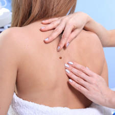 Lidé, kteří mají podezření na nezvyklé znaménkové útvary by měli jít na vyšetření, které dermatolog provede dermastoskopem