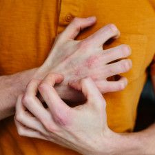 Atopický ekzém je chronické a svědivé kožní onemocnění